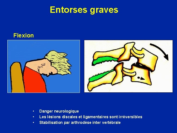 Entorses graves Flexion • • • Danger neurologique Les lésions discales et ligamentaires sont