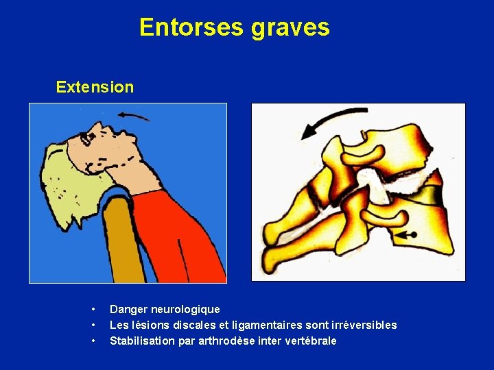 Entorses graves Extension • • • Danger neurologique Les lésions discales et ligamentaires sont