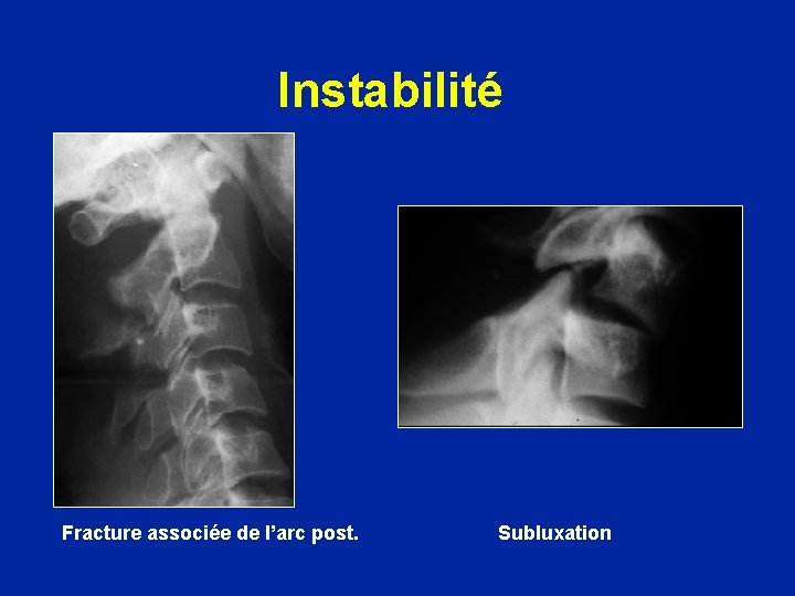 Instabilité Fracture associée de l’arc post. Subluxation 