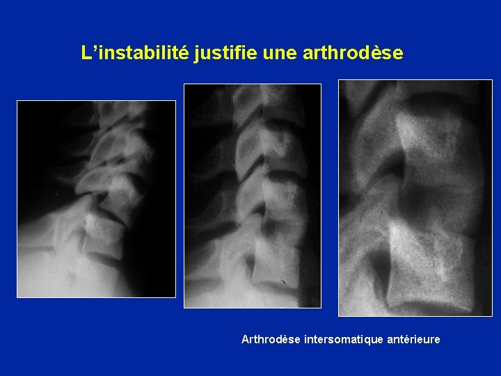 L’instabilité justifie une arthrodèse Arthrodèse intersomatique antérieure 