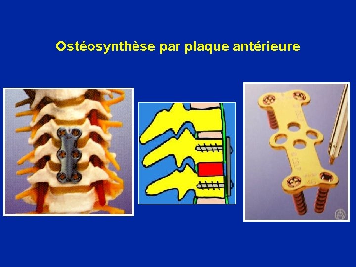 Ostéosynthèse par plaque antérieure 