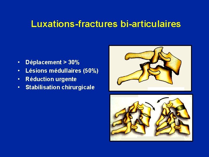 Luxations-fractures bi-articulaires • • Déplacement > 30% Lésions médullaires (50%) Réduction urgente Stabilisation chirurgicale