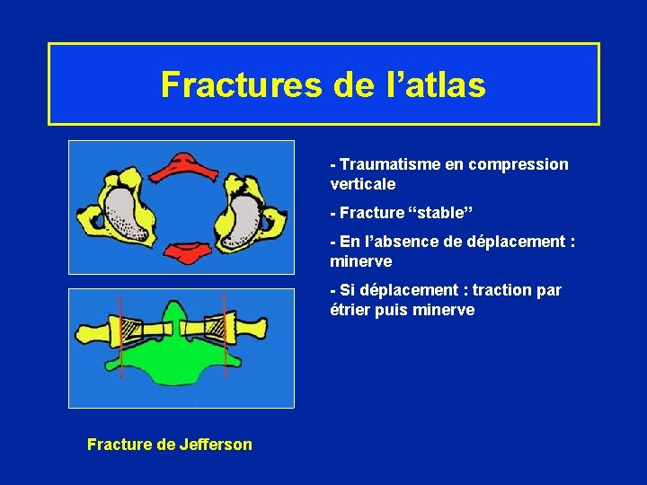 Fractures de l’atlas - Traumatisme en compression verticale - Fracture “stable” - En l’absence