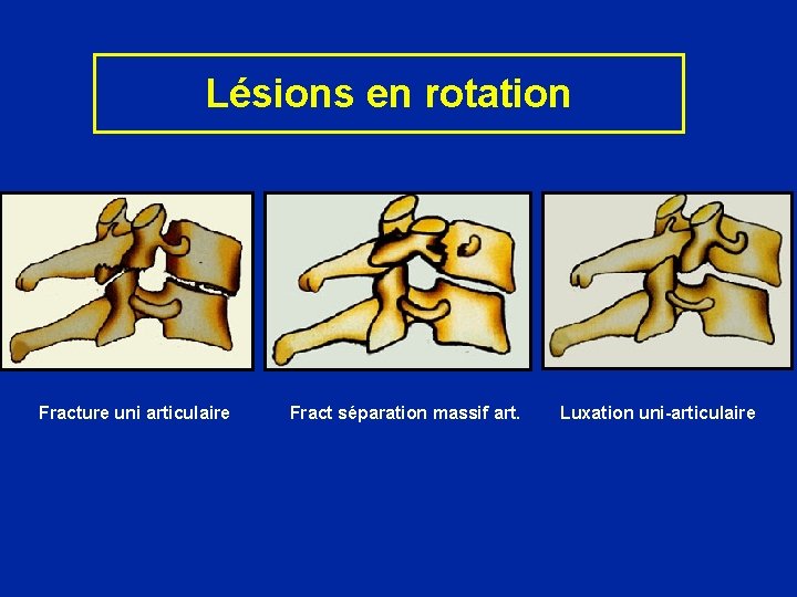 Lésions en rotation Fracture uni articulaire Fract séparation massif art. Luxation uni-articulaire 