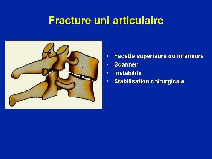 Fracture uni articulaire • • Facette supérieure ou inférieure Scanner Instabilité Stabilisation chirurgicale 