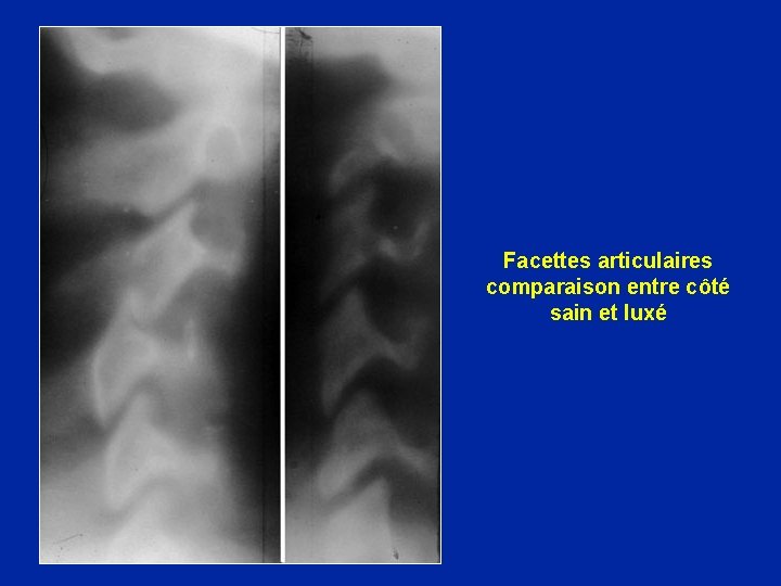 Facettes articulaires comparaison entre côté sain et luxé 
