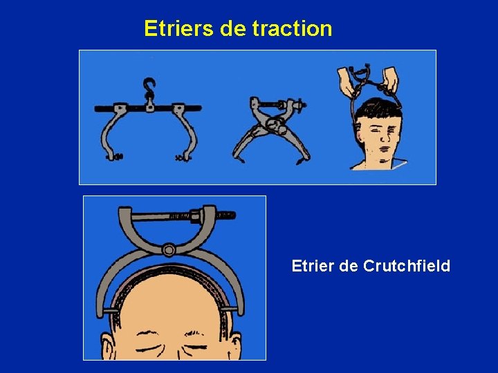 Etriers de traction Etrier de Crutchfield 