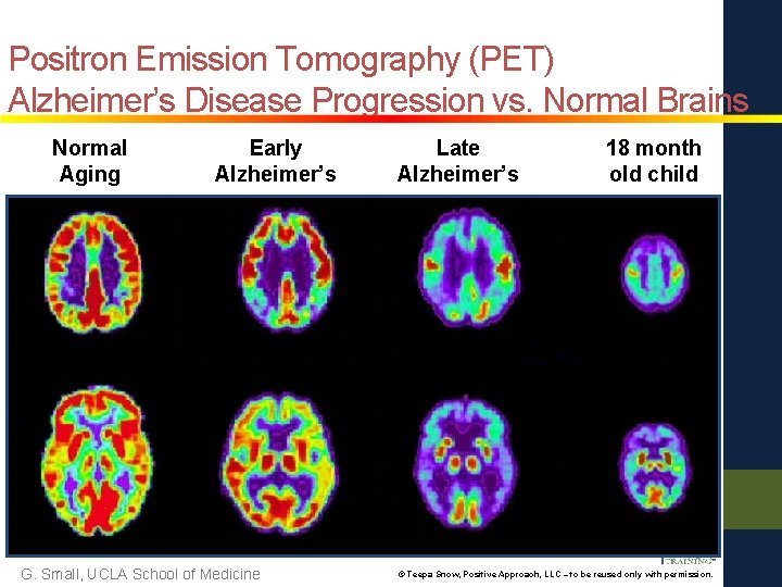 Positron Emission Tomography (PET) Alzheimer’s Disease Progression vs. Normal Brains Normal Aging Early Alzheimer’s