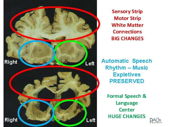 Sensory Strip Motor Strip White Matter Connections BIG CHANGES Right Left Automatic Speech Rhythm