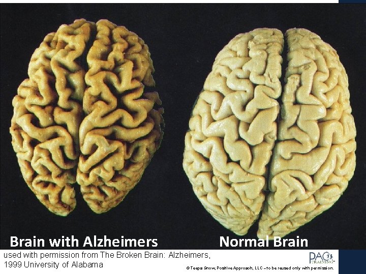 Brain with Alzheimers Normal Brain used with permission from The Broken Brain: Alzheimers, 1999