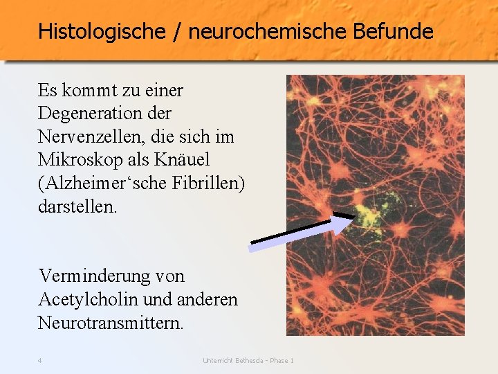 Histologische / neurochemische Befunde Es kommt zu einer Degeneration der Nervenzellen, die sich im