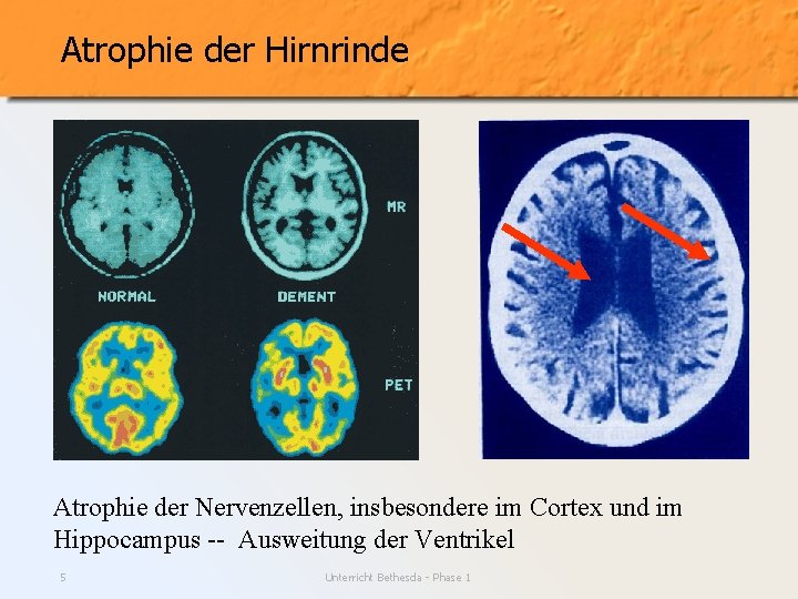 Atrophie der Hirnrinde Atrophie der Nervenzellen, insbesondere im Cortex und im Hippocampus -- Ausweitung