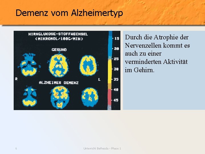 Demenz vom Alzheimertyp Durch die Atrophie der Nervenzellen kommt es auch zu einer verminderten