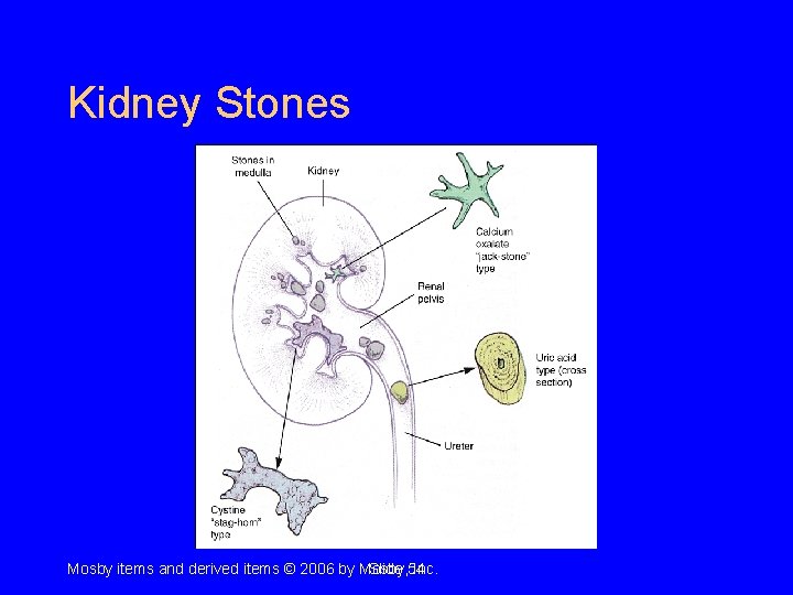 Kidney Stones Mosby items and derived items © 2006 by Mosby, Slide 54 Inc. Kidney Stones Mosby items and derived items © 2006 by Mosby, Slide 54 Inc.