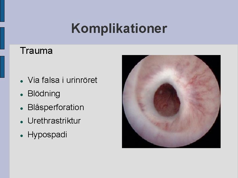 Komplikationer Trauma Via falsa i urinröret Blödning Blåsperforation Urethrastriktur Hypospadi Komplikationer Trauma Via falsa i urinröret Blödning Blåsperforation Urethrastriktur Hypospadi