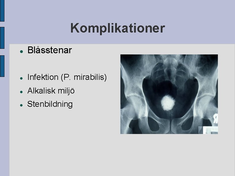 Komplikationer Blåsstenar Infektion (P. mirabilis) Alkalisk miljö Stenbildning Komplikationer Blåsstenar Infektion (P. mirabilis) Alkalisk miljö Stenbildning