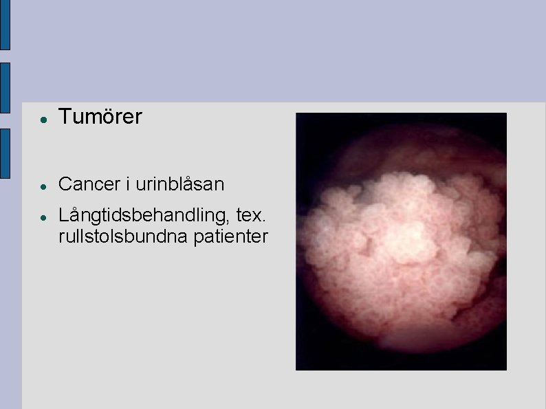 Tumörer Cancer i urinblåsan Långtidsbehandling, tex. rullstolsbundna patienter Tumörer Cancer i urinblåsan Långtidsbehandling, tex. rullstolsbundna patienter