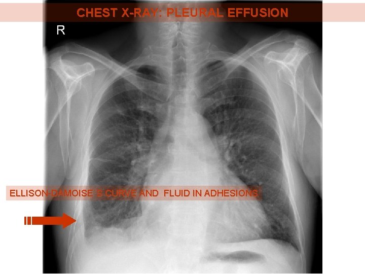 CHEST X-RAY: PLEURAL EFFUSION ELLISON-DAMOISE´S CURVE AND FLUID IN ADHESIONS 