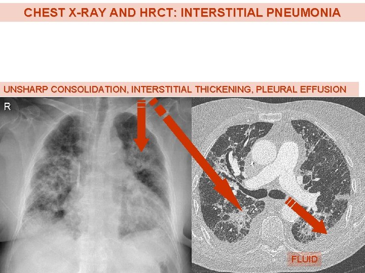 CHEST X-RAY AND HRCT: INTERSTITIAL PNEUMONIA UNSHARP CONSOLIDATION, INTERSTITIAL THICKENING, PLEURAL EFFUSION FLUID 