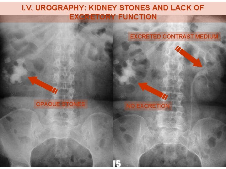 I. V. UROGRAPHY: KIDNEY STONES AND LACK OF EXCRETORY FUNCTION EXCRETED CONTRAST MEDIUM OPAQUE