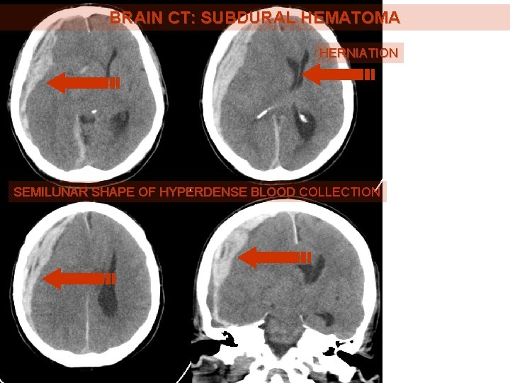 BRAIN CT: SUBDURAL HEMATOMA HERNIATION SEMILUNAR SHAPE OF HYPERDENSE BLOOD COLLECTION 