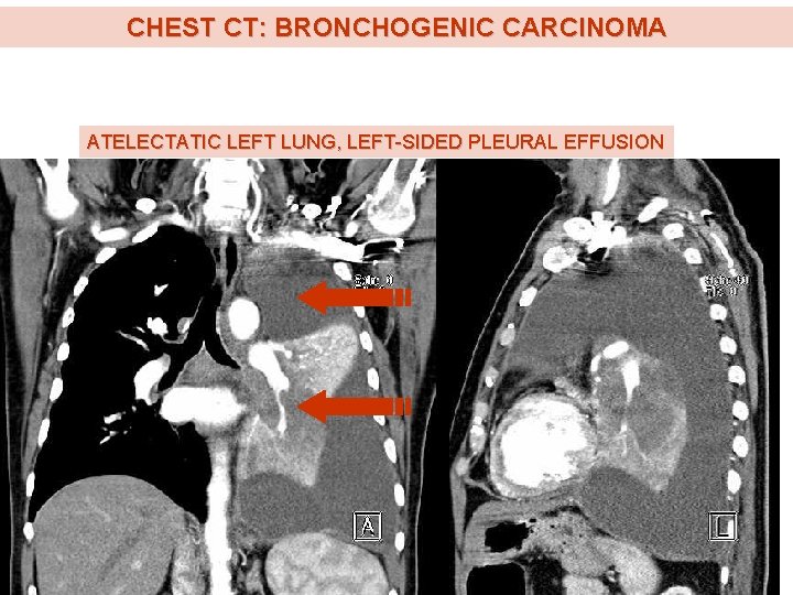 CHEST CT: BRONCHOGENIC CARCINOMA ATELECTATIC LEFT LUNG, LEFT-SIDED PLEURAL EFFUSION 