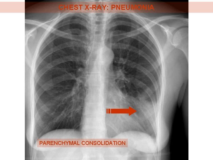 CHEST X-RAY: PNEUMONIA PARENCHYMAL CONSOLIDATION 