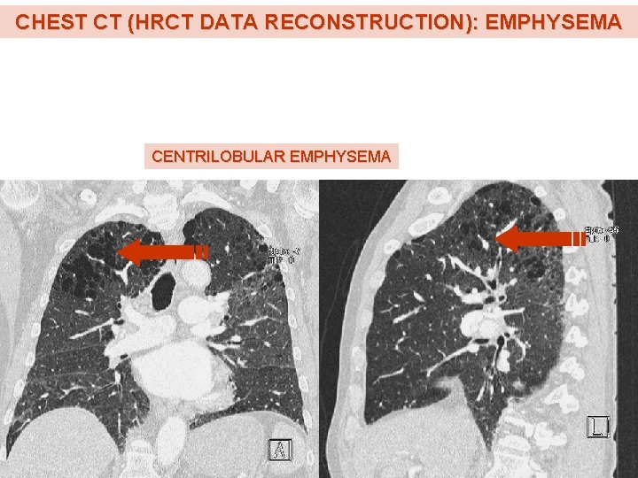 CHEST CT (HRCT DATA RECONSTRUCTION): EMPHYSEMA CENTRILOBULAR EMPHYSEMA 