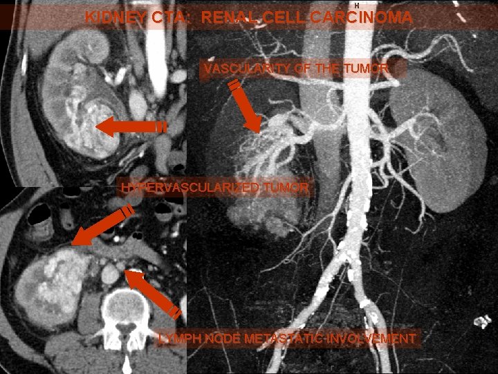 KIDNEY CTA: RENAL CELL CARCINOMA VASCULARITY OF THE TUMOR HYPERVASCULARIZED TUMOR LYMPH NODE METASTATIC