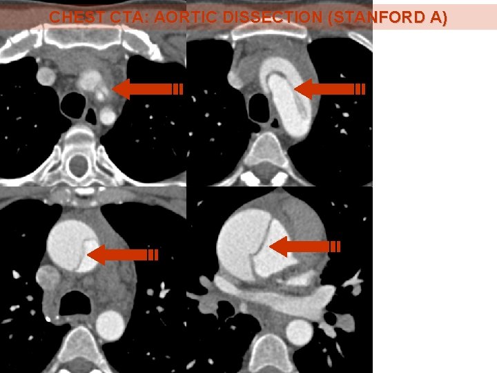 CHEST CTA: AORTIC DISSECTION (STANFORD A) 