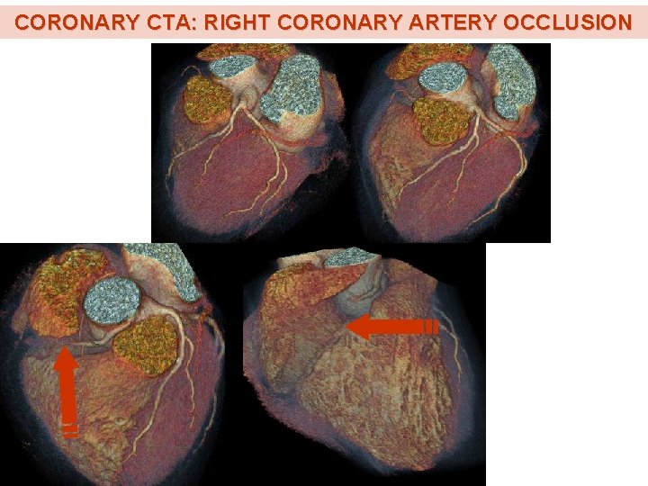 CORONARY CTA: RIGHT CORONARY ARTERY OCCLUSION 