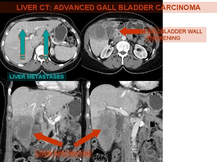 LIVER CT: ADVANCED GALL BLADDER CARCINOMA GALLBLADDER WALL THICKENING LIVER METASTASES LIVER INFILTRATION 