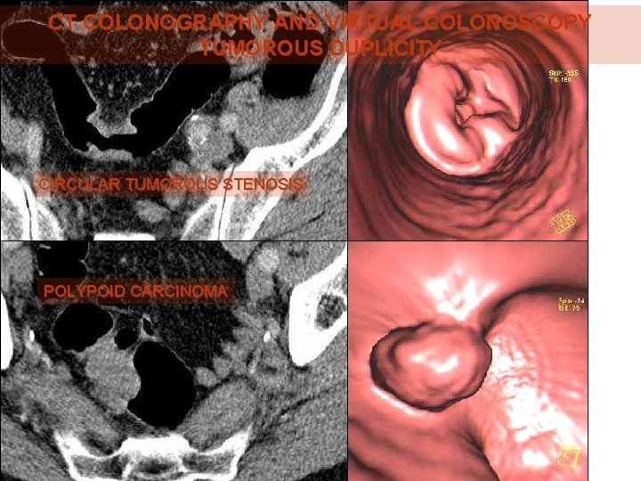CT COLONOGRAPHY AND VIRTUAL COLONOSCOPY TUMOROUS DUPLICITY CIRCULAR TUMOROUS STENOSIS POLYPOID CARCINOMA 