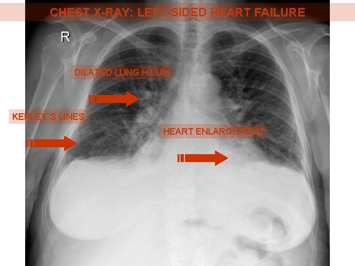 CHEST X-RAY: LEFT-SIDED HEART FAILURE DILATED LUNG HILUM KERLEY´S LINES HEART ENLARGEMENT 