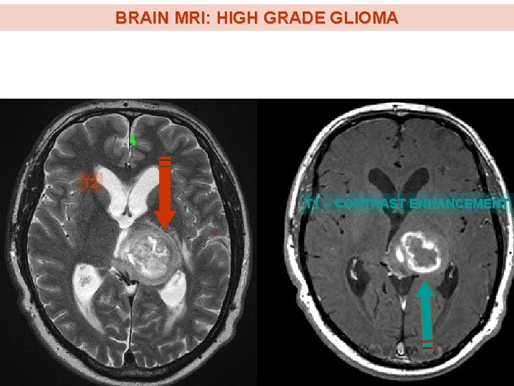 BRAIN MRI: HIGH GRADE GLIOMA T 2 T 1 – CONTRAST ENHANCEMENT 