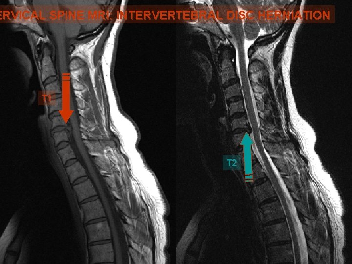 ERVICAL SPINE MRI: INTERVERTEBRAL DISC HERNIATION T 1 T 2 