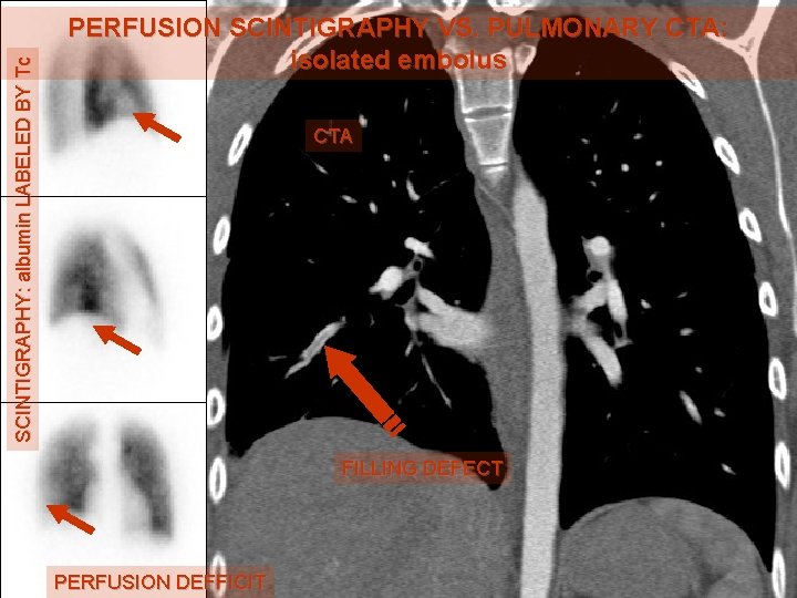 SCINTIGRAPHY: albumin LABELED BY Tc PERFUSION SCINTIGRAPHY VS. PULMONARY CTA: isolated embolus CTA FILLING