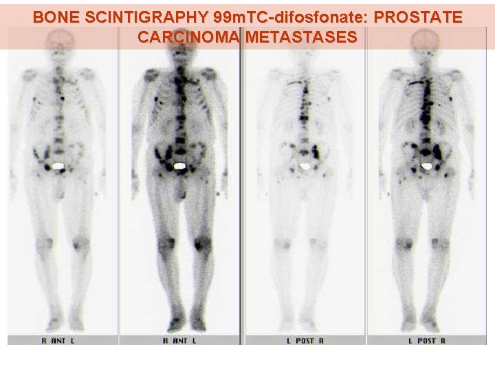 BONE SCINTIGRAPHY 99 m. TC-difosfonate: PROSTATE CARCINOMA METASTASES 