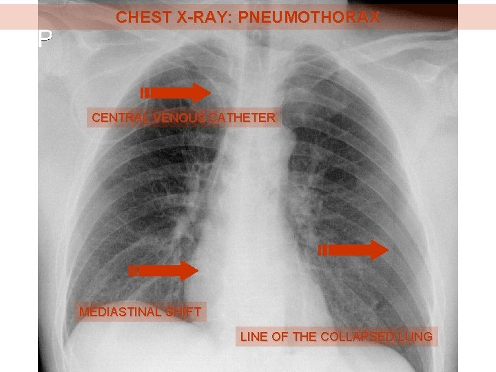 CHEST X-RAY: PNEUMOTHORAX CENTRAL VENOUS CATHETER MEDIASTINAL SHIFT LINE OF THE COLLAPSED LUNG 