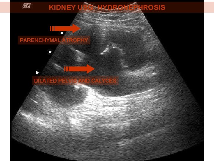 KIDNEY USG: HYDRONEPHROSIS PARENCHYMAL ATROPHY DILATED PELVIS AND CALYCES 