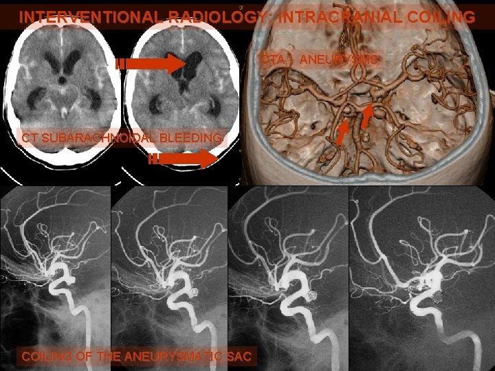 INTERVENTIONAL RADIOLOGY: INTRACRANIAL COILING CTA - ANEURYSMS CT SUBARACHNOIDAL BLEEDING COILING OF THE ANEURYSMATIC