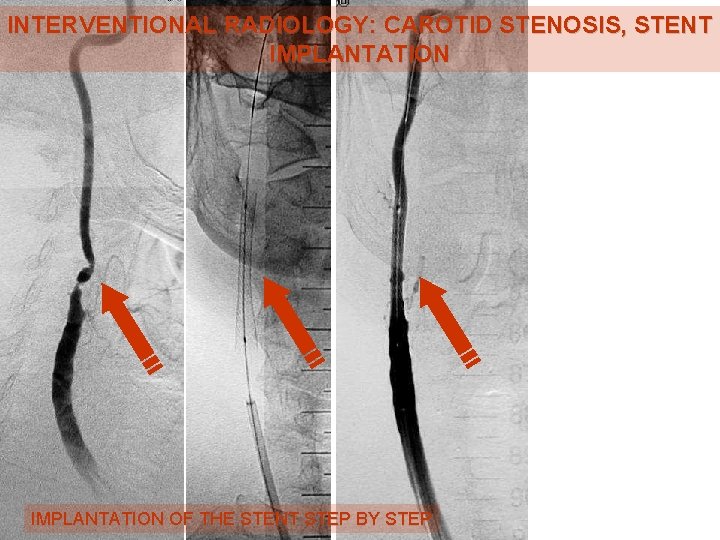 INTERVENTIONAL RADIOLOGY: CAROTID STENOSIS, STENT IMPLANTATION OF THE STENT STEP BY STEP 