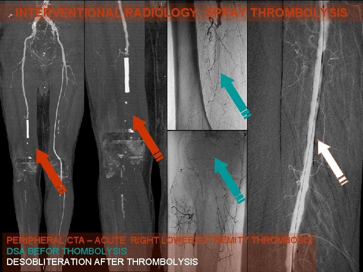 INTERVENTIONAL RADIOLOGY: SPRAY THROMBOLYSIS PERIPHERAL CTA – ACUTE RIGHT LOWER EXTREMITY THROMBOSIS DSA BEFOR