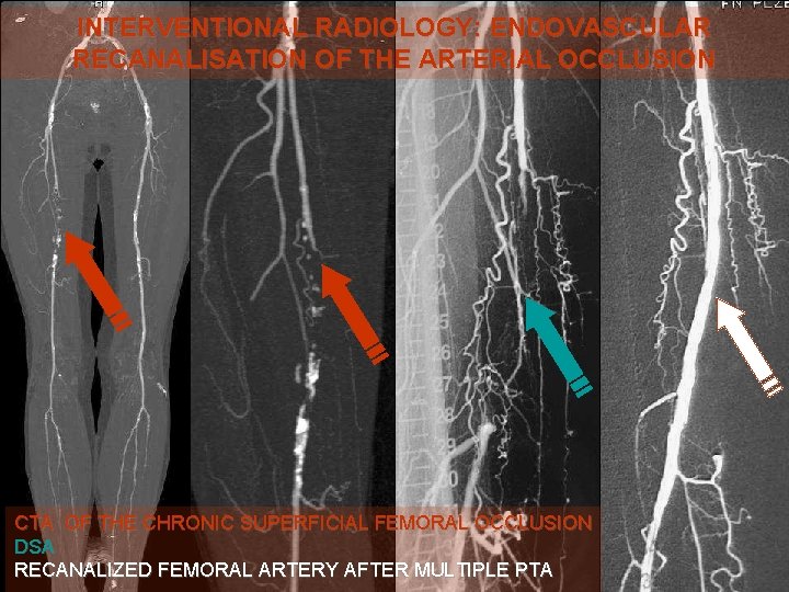INTERVENTIONAL RADIOLOGY: ENDOVASCULAR RECANALISATION OF THE ARTERIAL OCCLUSION CTA OF THE CHRONIC SUPERFICIAL FEMORAL
