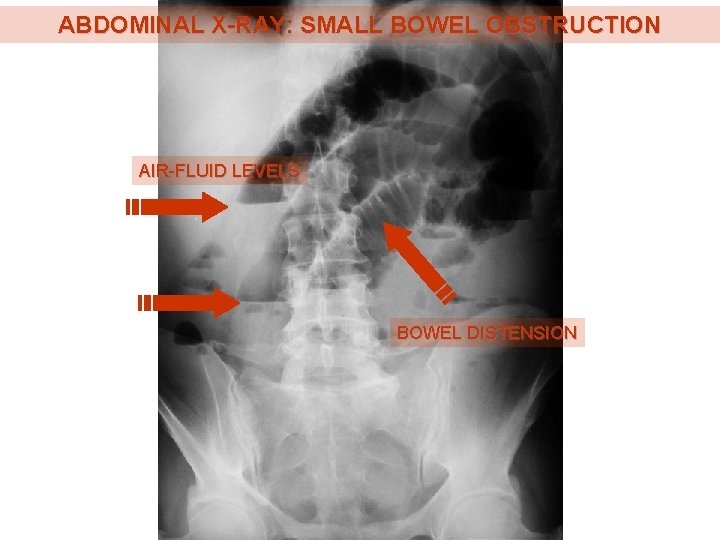 ABDOMINAL X-RAY: SMALL BOWEL OBSTRUCTION AIR-FLUID LEVELS BOWEL DISTENSION 