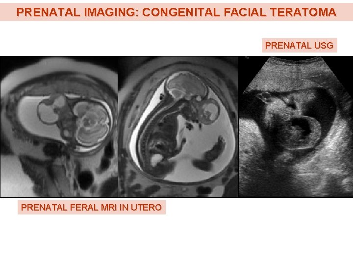 PRENATAL IMAGING: CONGENITAL FACIAL TERATOMA PRENATAL USG PRENATAL FERAL MRI IN UTERO 