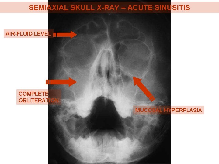 SEMIAXIAL SKULL X-RAY – ACUTE SINUSITIS AIR-FLUID LEVEL COMPLETE OBLITERATION MUCOSAL HYPERPLASIA 