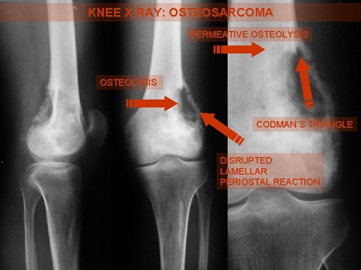 KNEE X-RAY: OSTEOSARCOMA PERMEATIVE OSTEOLYSIS CODMAN´S TRIANGLE DISRUPTED LAMELLAR PERIOSTAL REACTION 