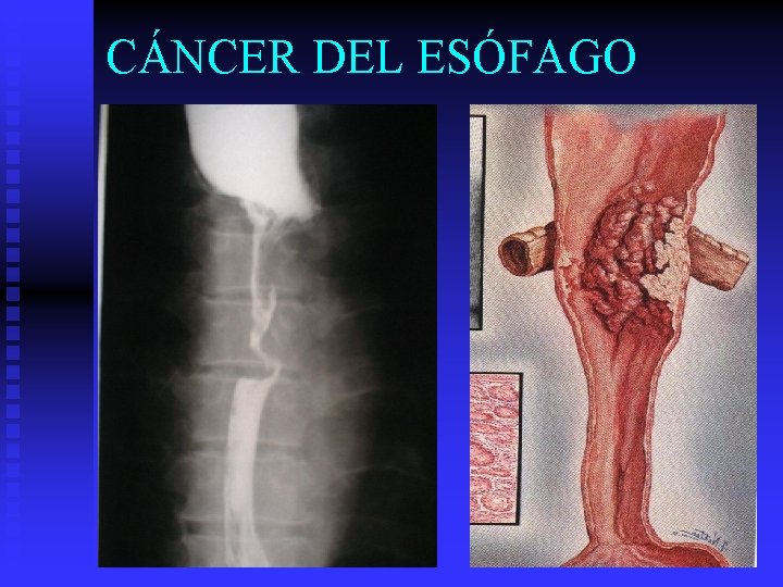 CÁNCER DEL ESÓFAGO 