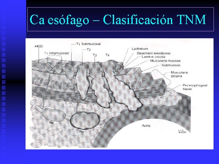 Ca esófago – Clasificación TNM 